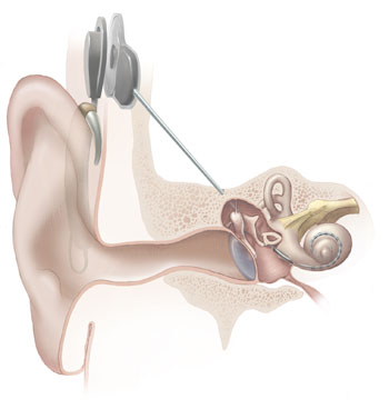 Кохлеарный имплантат. Cochlear implant.